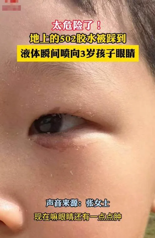 踩爆強力膠噴進孩子左眼慘被黏住 爸60秒神救援連醫生都讚教科書 第 5 張
