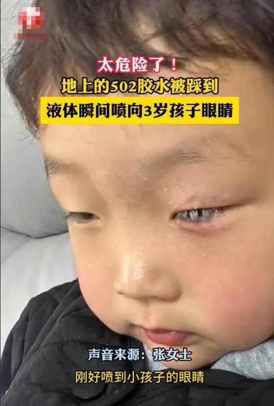 踩爆強力膠噴進孩子左眼慘被黏住 爸60秒神救援連醫生都讚教科書 第 2 張