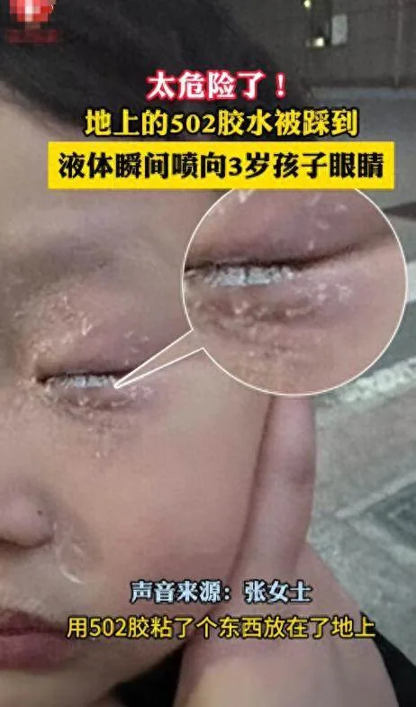 踩爆強力膠噴進孩子左眼慘被黏住 爸60秒神救援連醫生都讚教科書 第 1 張
