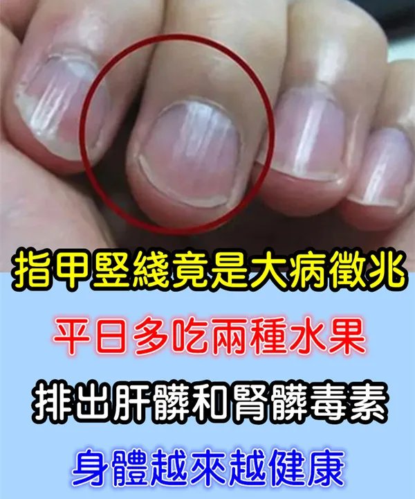 指甲豎線是大病徵兆?多吃蔓越莓、西瓜助排肝腎毒素 第 1 張